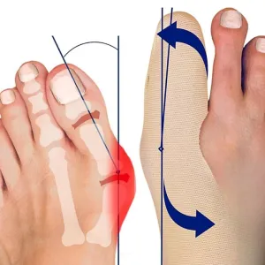 Ultra Thin Straightener Bunions Relief Socks